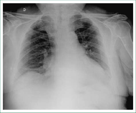 Pulmonary Thromboembolic Disease In This Patient We Can Find