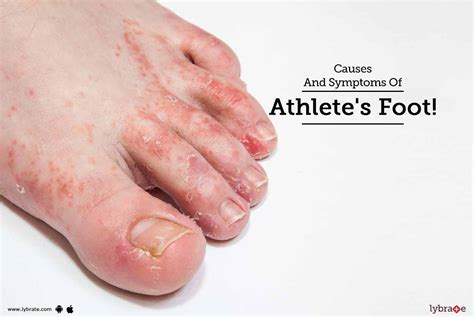 Causes And Symptoms Of Athletes Foot By Dr Asma Parveen Lybrate