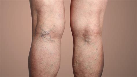 Varicose Veins Of The Legs These Symptoms That Should Alert You