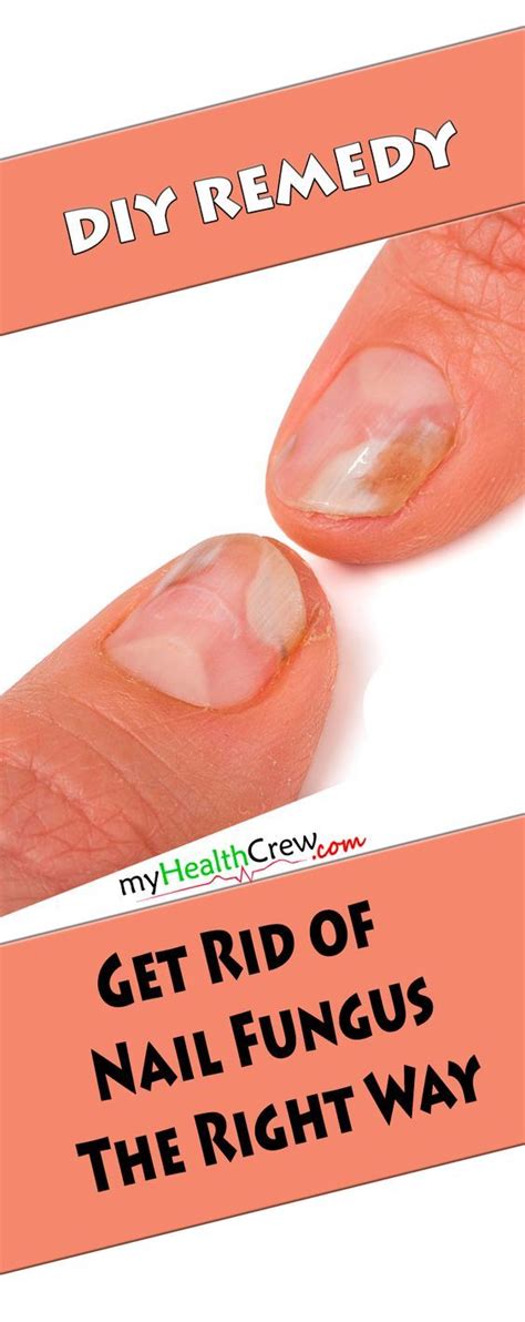 100 Pure Easy To Prepare Tool To Forever Get Rid Of Nail Fungus Nail