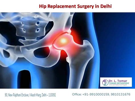 Total Hip Replacement Surgery In Delhi Hip Replacement Surgery Total