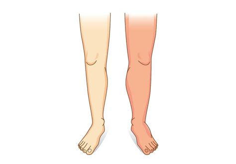 There are two types of oedema: Hypothyroidism and Water Retention - ThyroMate