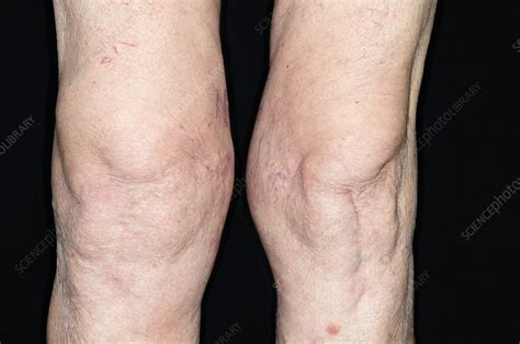 Swollen Knee Due To Osteoarthritis Stock Image C0168216 Science
