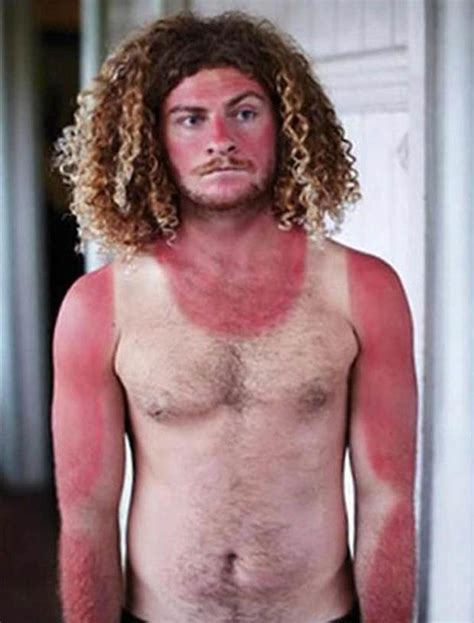 Uk Heatwave Worst Sun Tan Disasters Revealed Cringeworthy Snaps Show Awkward Fails Daily Star