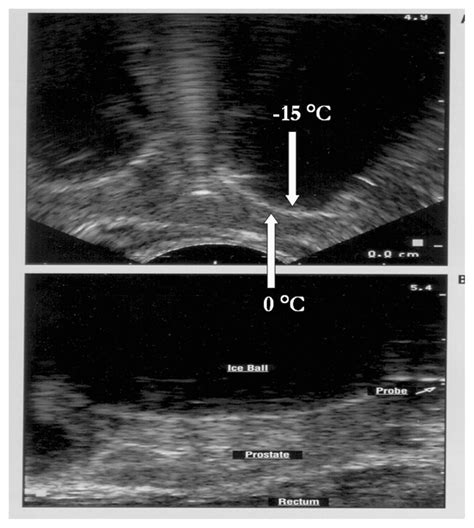 Transrectal Ultrasound Images Of A Human Prostate Cryoablation