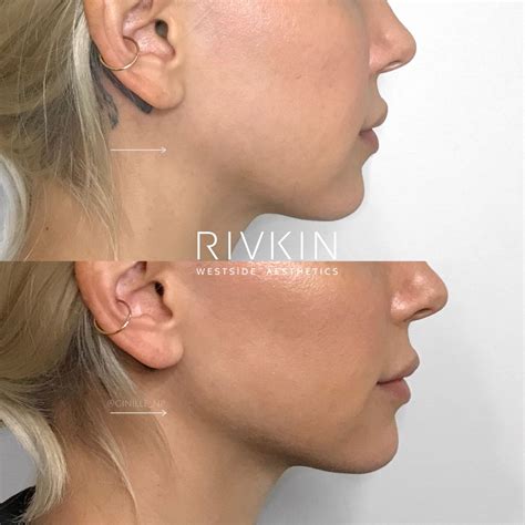 Jawline Jawfiller Nonsurgical Fillers Borox Westsideaesthetics