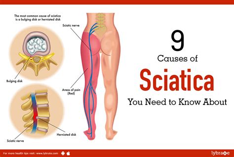 Top 9 Causes Of Sciatica Nerve Pain You Need To Know About By Dr