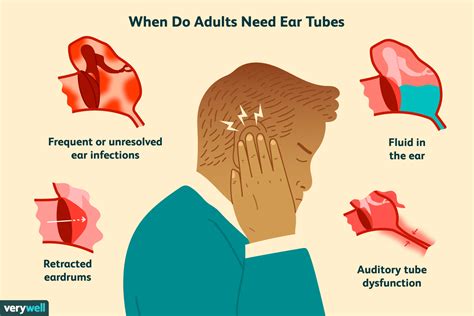 Ear Tube Placement Surgery In Adults Everything You Need To Know 2024