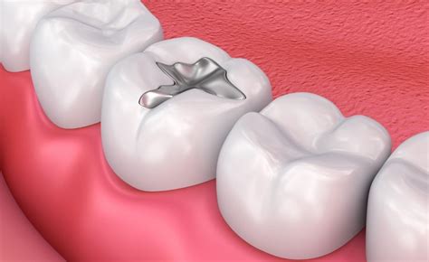 What Type Of Dental Filling Is Right For Me