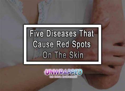 Five Diseases That Cause Red Spots On The Skin