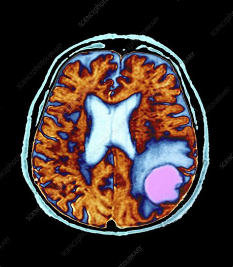 Secondary Brain Cancer Ct Scan Stock Image M1340660 Science