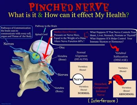 Pinched Nerves Painless Chiropractic And Neuropathy Treatment Center