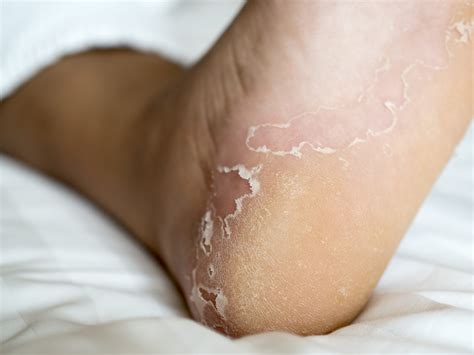 What Causes Itchy Feet Common Causes Jaws Podiatry