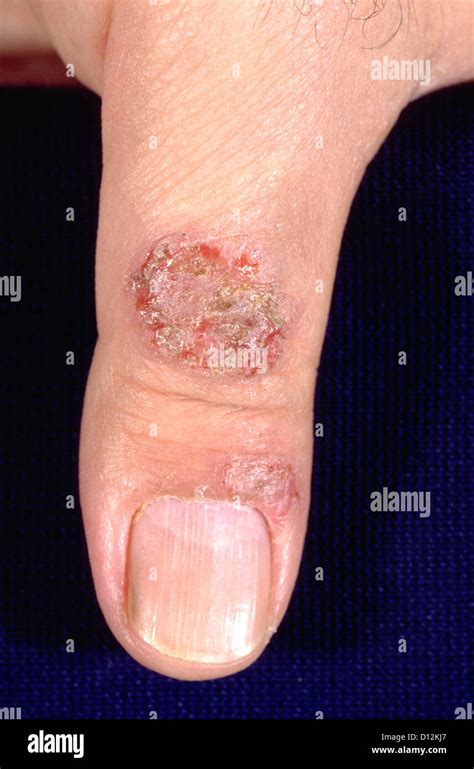 Discoid Eczema Nummular Dermatitis Stock Photo Alamy
