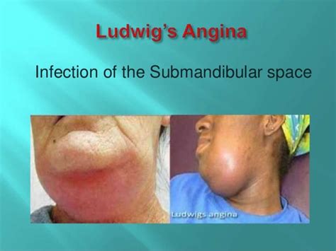 Ludwigs Angina