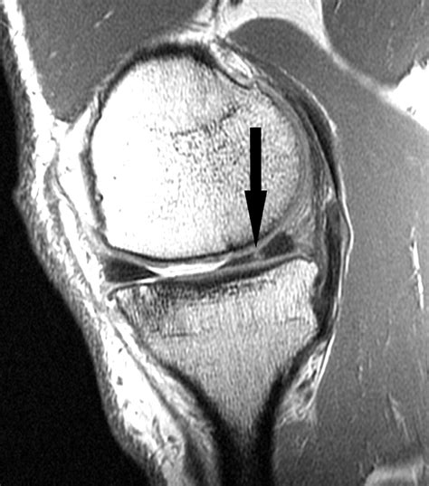 Accuracy Of 3 T Mri Using Fast Spin Echo Technique To Detect Meniscal