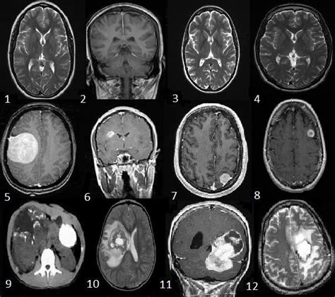 Sample Datasets Of Brain Tumor Mri Images Normal Brain Mri 1 To 4