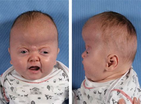 Figure 1 From Apert Syndrome The Paris And Rotterdam Philosophy