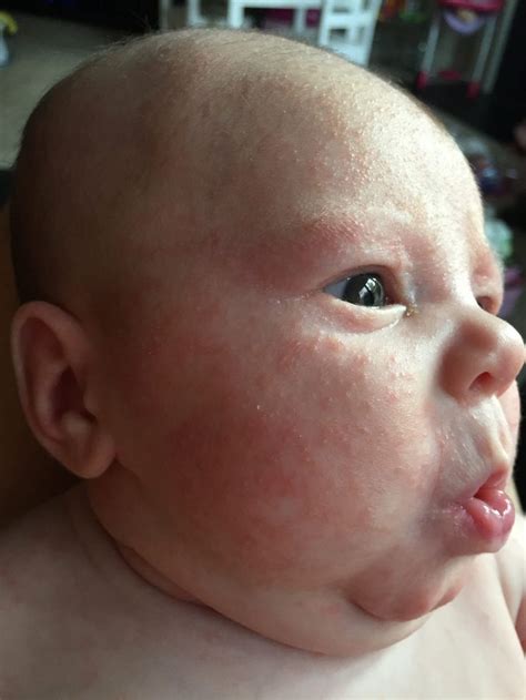 View 20 Baby Dry Skin Rash On Face Aegeantravelesz
