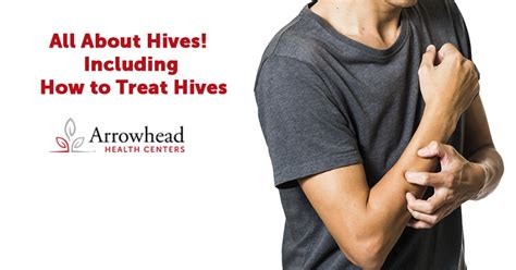 All About Hives Including How To Treat Hives Redirect Health Centers