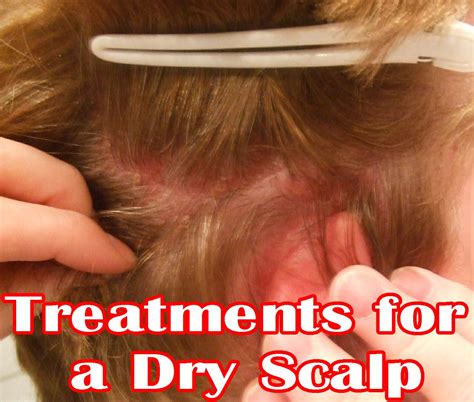 Treatments For A Dry Scalp Medi Queen Dry Scalp Dry Scalp Remedy