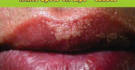 Oral Health White Spots On Lips Causes Directorio Odontológico