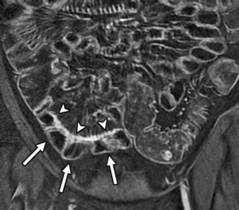 Small Bowel Crohn Disease At Ct And Mr Enterography Imaging Atlas And
