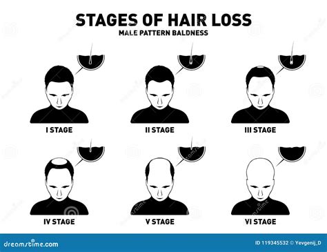 Hair Loss Stages And Types Of Male Hair Loss Male Pattern Baldness