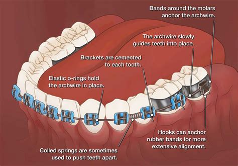Braces Dental Aligners How Do Braces In Orthodontics Work