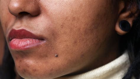 Skin Pigmentation Brown Patches