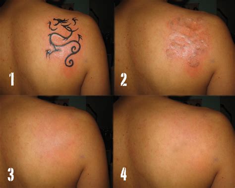 What To Expect From Laser Tattoo Removal North Houston Laser Tattoo