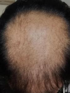 See the studies, photos, and answers. microneedling minoxidil & finasteride | WRassman,M.D ...