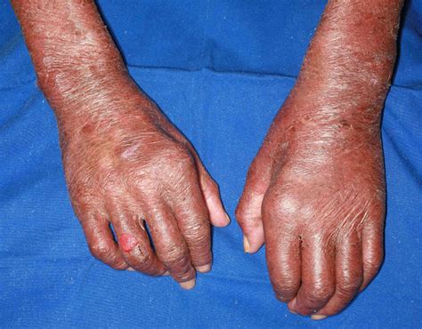 Erythema Nodosum Leprosum Leprosy The Clinical Advisor