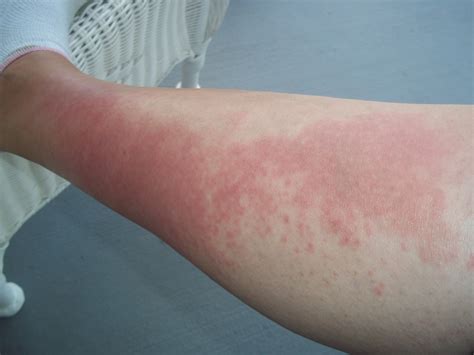 I Developed A Rash On My Legs That Was Itchy A Few Hours After