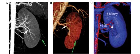 Preoperative Evaluation Of Renal Artery Anatomy Using Computed