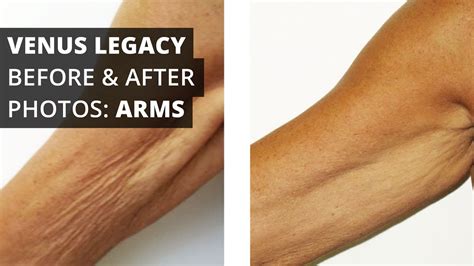 Venus Legacy™ Before And After Photos Arms Youtube