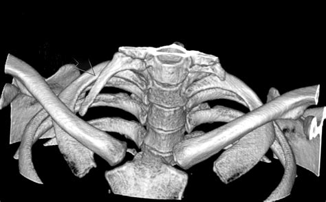 3d Ct Shows Right Side Dominant Cervical Ribs Download Scientific