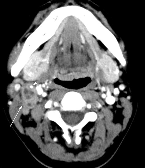 Kikuchi Disease Differentiation From Tuberculous Lymphadenitis Based