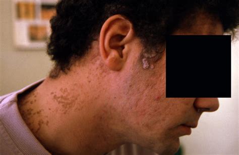 Benign Skin Lesions Nevi Cysts Naevus Verrucous Epidermal Picture
