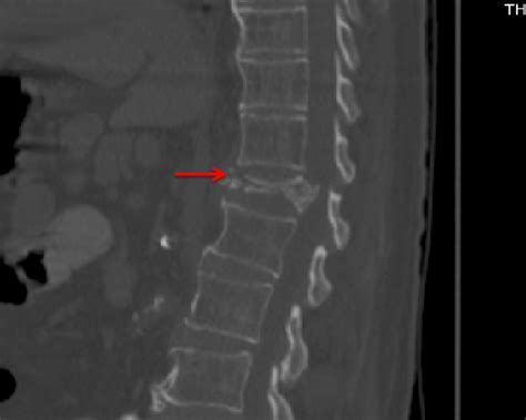 Compression Fractures Of The Spine Allspine