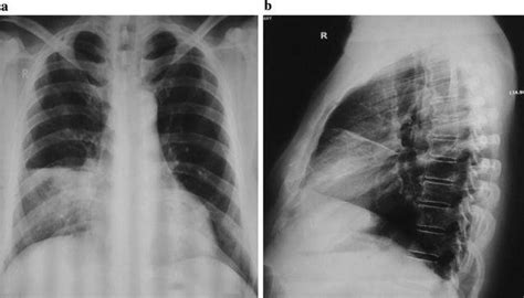 Chest X Ray A Postero Anterior And B Right Lateral View Showing