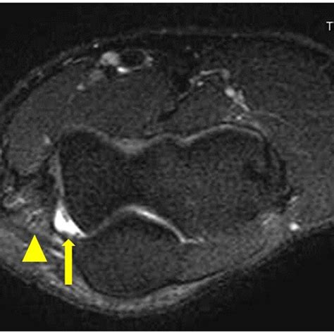 Clinical Signs Of Ulnar Neuropathy A Wartenbergs Sign Is Demonstrated