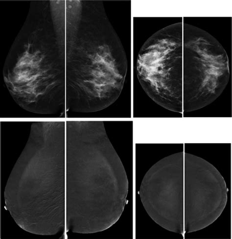 Contrast Enhanced Mammography Implementation Performance And Use For