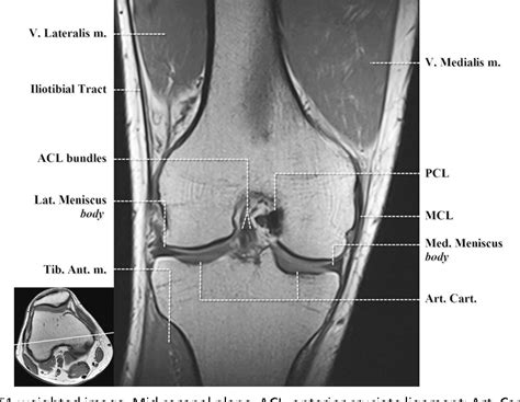 Knee Muscle Anatomy Mri Layered Approach To The Anterior Knee Normal