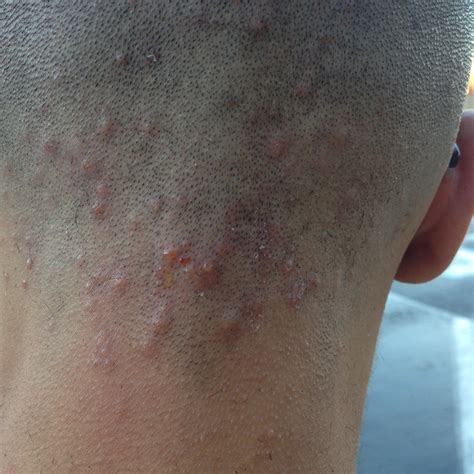 Hair Bumps On Back Of Neck