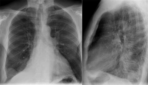 Right Lower Lobe Atelectasis Chest X Rays Of A 70 Year Grepmed