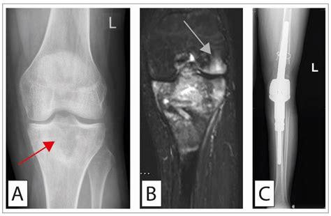 Cancers Free Full Text Surgical Treatment Of Bone Sarcoma