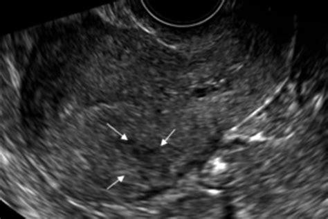 Sonography Of Adenomyosis Sakhel 2012 Journal Of Ultrasound In