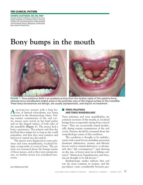 Bony Bumps In The Mouth Cleveland Clinic Journal Of Medicine