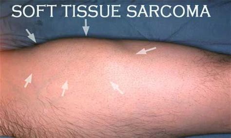 Shorter Radiation Regimen Safe Effective In Soft Tissue Sarcoma
